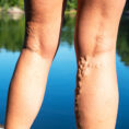 Closeup of a person's legs with varicose veins standing on a dock over a body of water