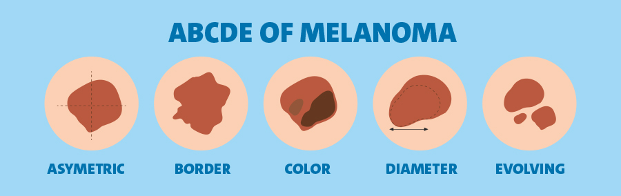 abcde of melanoma images of the different warning signs
